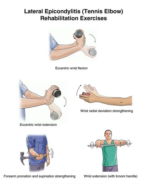 tennis elbow